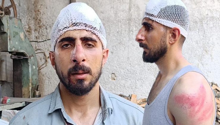50 kilometre hız dayağı! Burnu kırıldı, başına 8 dikiş atıldı