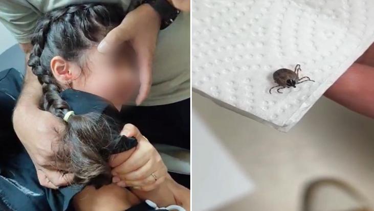Bir aydır kulak ağrısı çekiyordu! Kulağında canlı kene bulundu