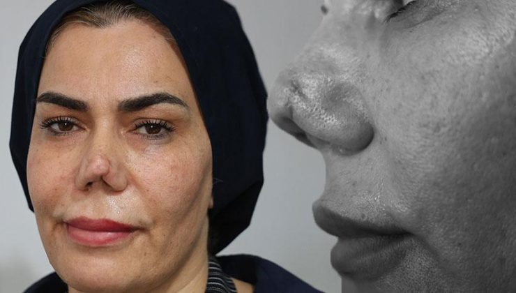 Burnu kırıldı, 4 operasyon sonrası hayatı kabusa döndü: Resmen hayattan koptum