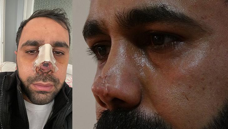 Burun ameliyatı sonrası hayatı kabusa döndü! 40 bin Euro’luk tedavi çıktı