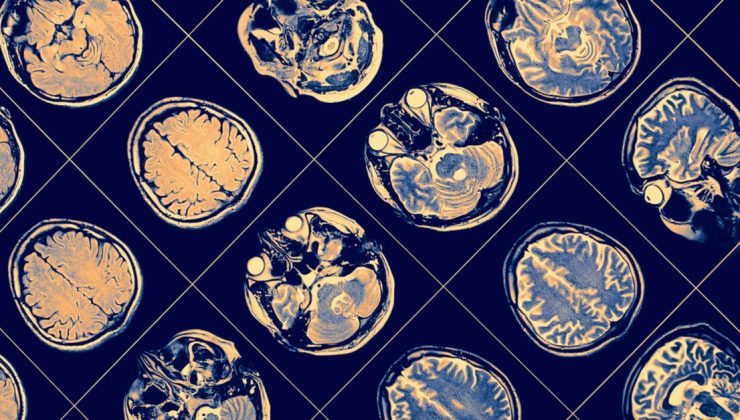 Alzheimer tanısında kan testi dönemi!