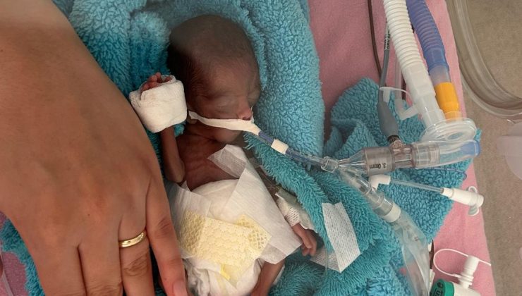 Aydın’da 350 gram doğan Rüzgar bebek, 240 günlük yaşam mücadelesini kazandı